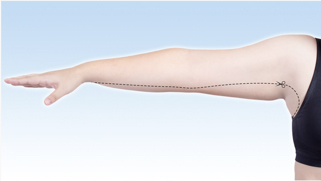 El tamaño de la incisión puede variar en función del grado individual de flacidez y del resultado deseado del tratamiento. La imagen muestra una incisión esquemática para un lifting planificado de la parte superior del brazo.
