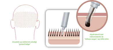 Mit modernen Spezialbohrern gelingt die präzise Entnahme der Haarwurzeln am Hinterkopf. Das Bild zeigt ein Schema der Haarfollikelentnahme mit einem Spezialbohrer