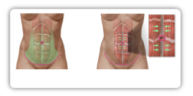 Im Rahmen einer großen Bauchdeckenstraffung können auch die geraden Bauchmuskeln wieder gerichtet werden, um einer Vorwölbung der Bauchhöhle vorzubeugen. Im Bild ist das Verfahren schematisch dargestellt. 