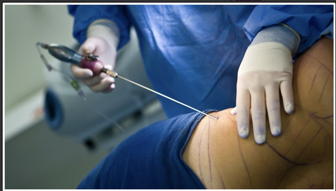 La liposucción puede eliminar la grasa de forma selectiva y suave mediante procedimientos mínimamente invasivos. La foto muestra una liposucción mínimamente invasiva.