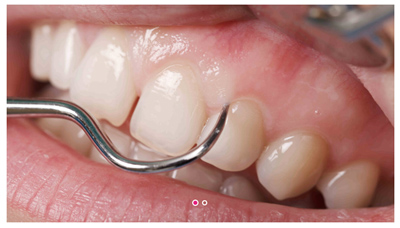 Bei estethica nehmen wir eine gründliche Behandlung von Zahnfleischentzündungen vor. Das Bild zeigt die Reinigung des Zahnfleischrands