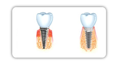 Comparación de un implante dental convencional y uno moderno. 