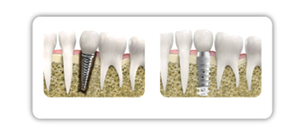Los implantes deben insertarse con precisión milimétrica. La imagen muestra una comparación de prótesis mal colocadas y correctamente implantadas. 