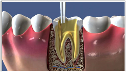 Um die entzündete Zahnpulpa zu erreichen und reinigen zu können, wird ein Zugang zum Zahnmark gelegt. Das Bild zeigt die schematische Darstellung einer Zahnwurzelöffnung. 