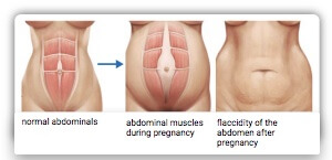 During pregnancy, the straight abdominal muscles can diverge. The picture shows schematically the course and the skin appearance of diverging abdominal muscles.