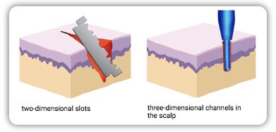 In the sapphire percutaneous technique, we use highly sensitive needle devices with sapphire tips that allow particularly precise work. The picture shows schematically the transplantation techniques of the FUE method and the sapphire percutaneous technique.