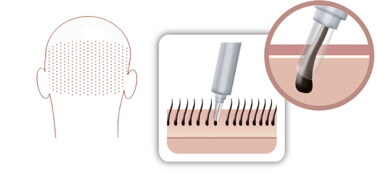 Modern special drills enable precise removal of the hair roots at the back of the head. The picture shows a diagram of the hair follicle removal with a special drill.