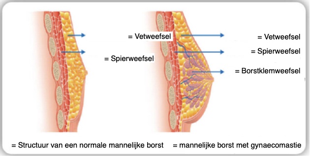 Structuur van een normale mannelijke borst & mannelijke borst met gynaecomastie